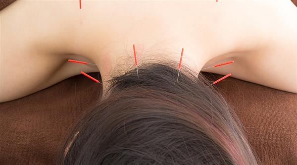 中醫(yī)針灸有何療效？石家莊炎黃針灸推拿學校為你分享！